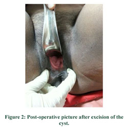 A large posterior vaginal wall cyst simulating rectocele: an account of an  unusual perplexing case - Document - Gale Academic OneFile