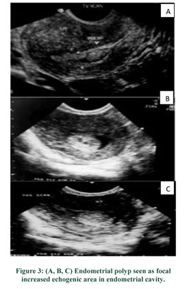 How useful is ultrasound to evaluate patients with postmenopausal bleeding?  - Document - Gale Academic OneFile