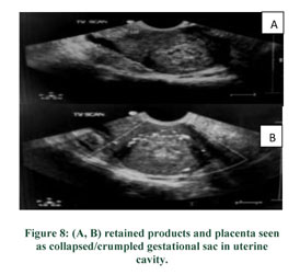 How useful is ultrasound to evaluate patients with postmenopausal bleeding?  - Document - Gale Academic OneFile