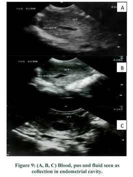 How useful is ultrasound to evaluate patients with postmenopausal bleeding?  - Document - Gale Academic OneFile