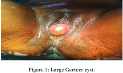 Cureus, A Rare Case of Posterior Vaginal Wall Gartner's Duct Cyst  Mimicking as Genital Prolapse