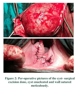 A large posterior vaginal wall cyst simulating rectocele: an account of an  unusual perplexing case - Document - Gale OneFile: Health and Medicine