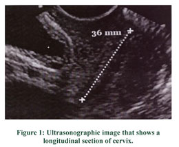 a B-mode image demonstrating a cervical length measurement. Cervical