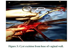A rare case of gartner duct cyst presenting as a genital prolapse: a case  report - Document - Gale Academic OneFile