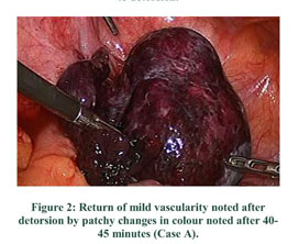 Laparoscopic resection of a torted ovarian dermoid cyst, World Journal of  Emergency Surgery