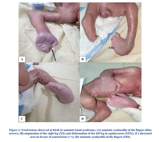 Austin is a congenital partial foot amputee due to amniotic band syndr