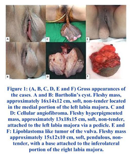 Fleshy Mass Passed Vaginally by a Young Woman