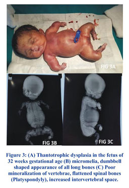 thanatophoric dysplasia