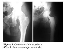 Evolution of mould arthroplasty of the hip joint.
