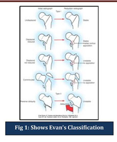 evans hip fracture classification