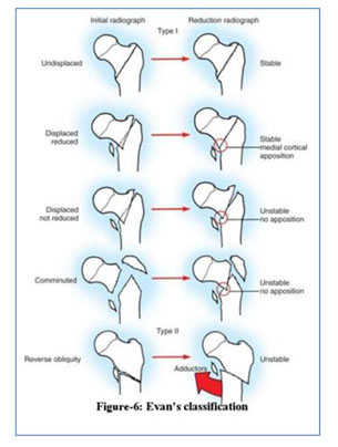 Peritrochanteric fractures--surgical management by PF--LCP - Document ...