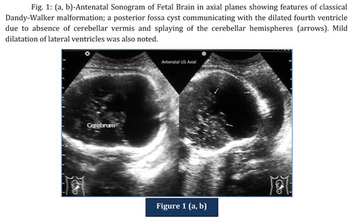 cerebellar vermis ultrasound