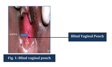 blind vaginal pouch