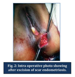 episiotomy scar tissue treatment