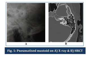mastoid air cells x ray