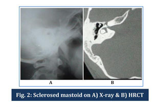 A Comparative Study Of Plain X Ray Mastoids With Hrct Temporal Bone In Patients With Chronic Suppurative Otitis Media Document Gale Onefile Health And Medicine
