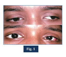 Surgical Outcome Of Intermittent Exotropia Document Gale Academic Onefile