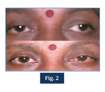 Surgical Outcome Of Intermittent Exotropia Document Gale Academic Onefile