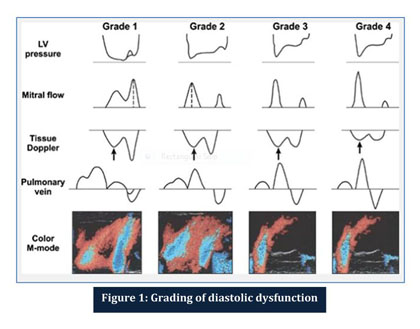 What Is Grade 1 Lv Diastolic Dysfunction