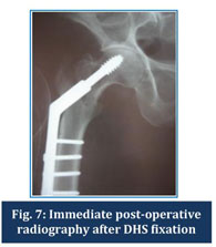 A comparative study of functional outcome between dynamic hip screw and proximal  femoral nail in surgical management of per-trochanteric fractures -  Document - Gale Academic OneFile