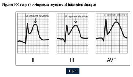 myocardial infarction ecg strip