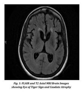 Gale Onefile Health And Medicine Document Eye Of Tiger Sign Clinical Phenotypes