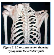 Sprengel's deformity of left scapula (high position of scapula