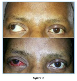 Surgical Outcome Of Unilateral Lateral Rectus Recession And Medial Rectus Resection In Large Angle Exotropia Document Gale Onefile Health And Medicine