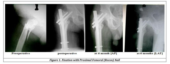 A STUDY ON COMPARISON OF RESULTS OF PROXIMAL FEMORAL NAIL AND DHS IN  UNSTABLE PROXIMAL FEMORAL FRACTURES - Document - Gale OneFile: Health and  Medicine