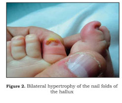 Triangular shaped nail of the hallux in a 3-day-old baby. Figure 2.