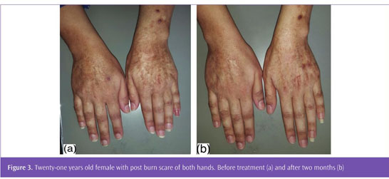 Medical Therapy of Burn Scar Before Any Plastic Surgery by Using Topical  Corticosteroid Combined with Oral Zinc Sulfate. - Document - Gale Academic  OneFile