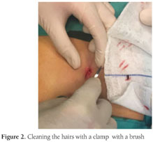 Endoscopic pilonidal sinus treatment (E.P.Si.T.): a minimally invasive  approach - ScienceDirect