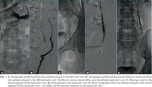 Selecting patients for embolization of varicoceles based on  ultrasonography. - Document - Gale Academic OneFile