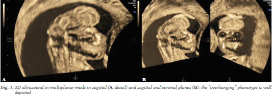 anencephaly 3d ultrasound