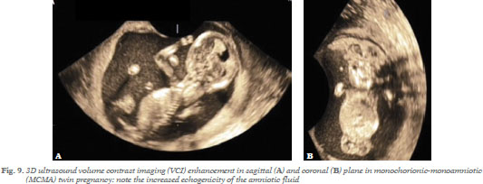anencephaly 3d ultrasound