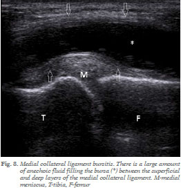 Medial Collateral Ligament Tear - The Surrey Osteopaths