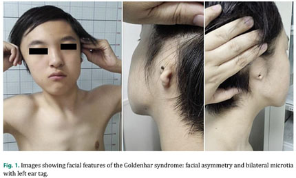 goldenhar syndrome ear