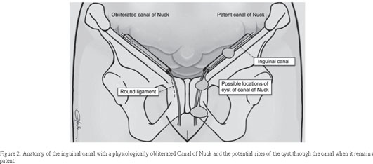 Canal of Nuck Abnormalities in Pediatric Female Patients