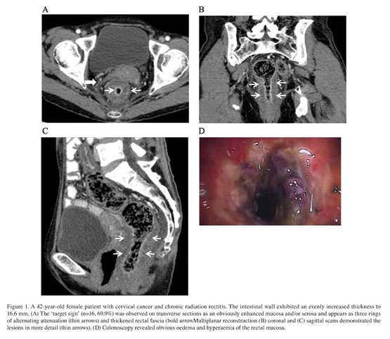 Multi slice spiral CT evaluation of chronic radiation colitis and