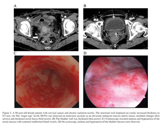 Multi slice spiral CT evaluation of chronic radiation colitis and