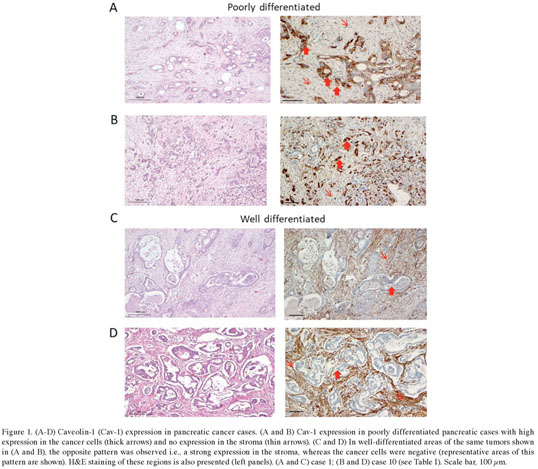 The different functions and clinical significances of caveolin-1 in human  adenocarcinoma and squamous cell carcinoma - Document - Gale OneFile:  Health and Medicine