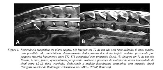 A e B. Ressonância magnética (T1) evidenciando hérnia discal