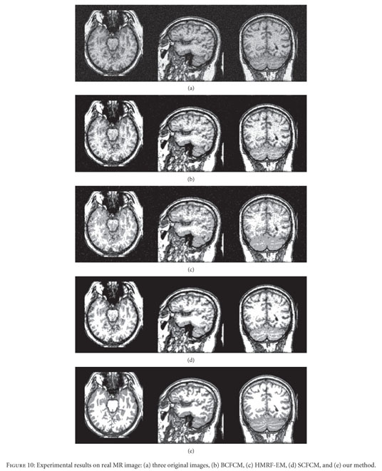 Brain Tissue Segmentation and Bias Field Correction of MR Image