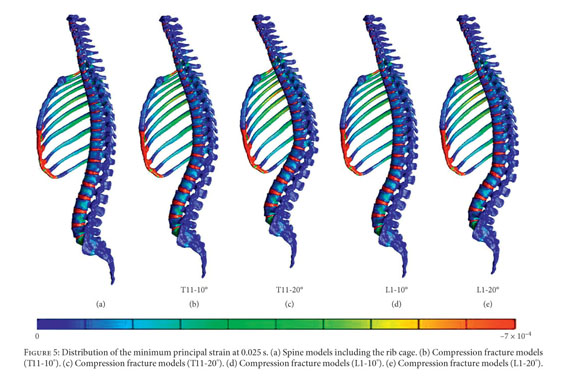 Finite element analysis of compression fractures at the thoracolumbar  junction using models constructed from medical images