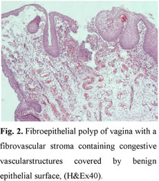 A Year Old Girl With Fibroepithelial Polyp Of The Vagina Presenting