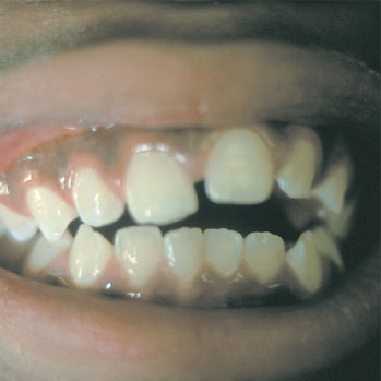 This patients teeth are misarranged because of excessive thumb sucking.