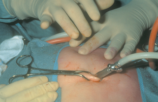 A surgeon performs a laparoscopic cholecystectomy on a patient.