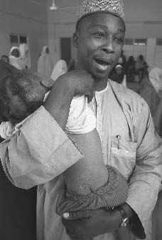 At a clinic in Nigeria in 2005, a man is shown carrying his oneyear-old child, who is suffering from a skin condition caused by measles. Hundreds of children died from an upsurge in measles cases, despite a series of local vaccination campaigns