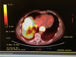Cancer - PET scan showing cancer cells