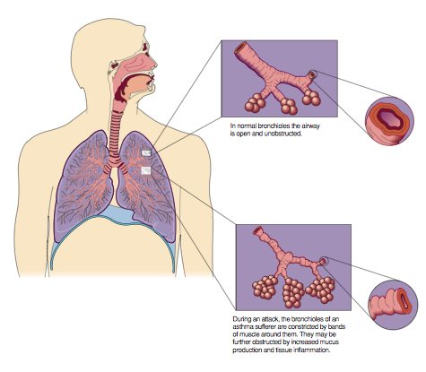 how does asthma affect lungs